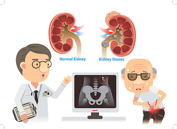 Doctors are advising the old kidney stones.